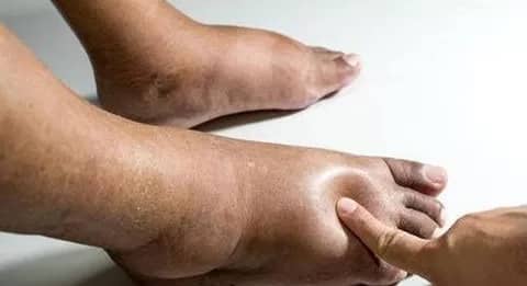 FIVE CONDITIONS THAT MAKE YOUR LEGS SWELL.